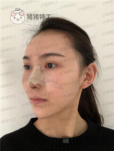 上海愉悦美联臣荣峥鼻部手术案例价格分享,让我嫌弃的鼻子终于给我自信了!