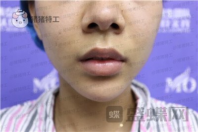 长沙美沃孔伟立厚唇改薄案例价格分享,一个好看的嘴巴让整个人变得可爱!