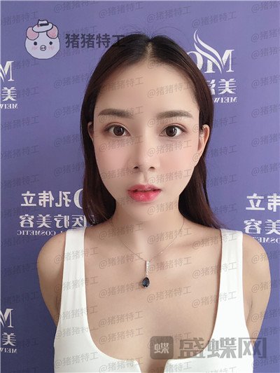 长沙美沃孔伟立厚唇改薄案例价格分享,一个好看的嘴巴让整个人变得可爱!