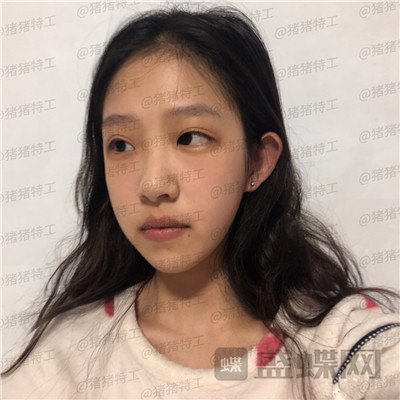 杭州美莱韩超鼻部手术案例价格分享,刚做完像热巴的鼻子好喜欢~