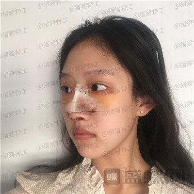 杭州美莱韩超鼻部手术案例价格分享,刚做完像热巴的鼻子好喜欢~