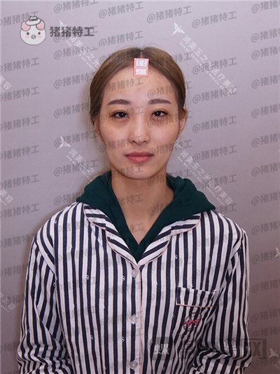 北京润美玉之光王明利面部填充案例价格分享,法令纹显老全部消失了回到18岁~