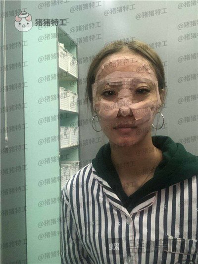 北京润美玉之光王明利面部填充案例价格分享,法令纹显老全部消失了回到18岁~