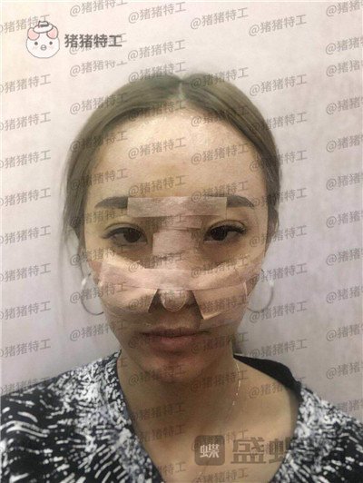 北京润美玉之光王明利面部填充案例价格分享,法令纹显老全部消失了回到18岁~