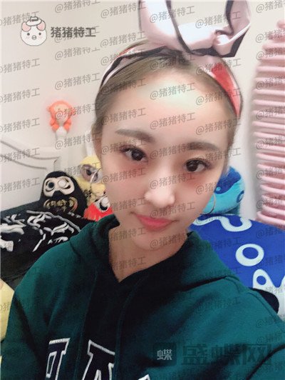 北京润美玉之光王明利面部填充案例价格分享,法令纹显老全部消失了回到18岁~