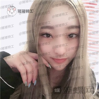 北京润美玉之光王明利面部填充案例价格分享,法令纹显老全部消失了回到18岁~