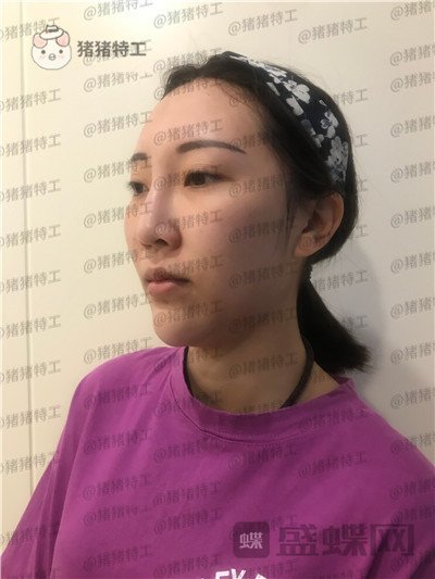 北京玲珑梵宫张殿祥面部填充案例价格分享,额头不完美对整张脸有多大影响?