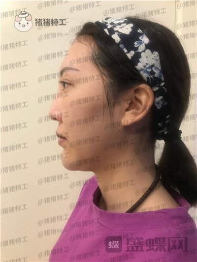 北京玲珑梵宫张殿祥面部填充案例价格分享,额头不完美对整张脸有多大影响?