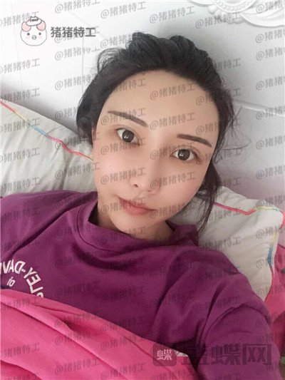 北京玲珑梵宫张殿祥面部填充案例价格分享,额头不完美对整张脸有多大影响?