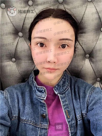 北京玲珑梵宫张殿祥面部填充案例价格分享,额头不完美对整张脸有多大影响?