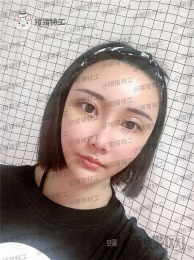 北京玲珑梵宫张殿祥面部填充案例价格分享,额头不完美对整张脸有多大影响?
