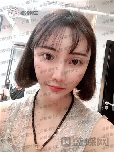 北京玲珑梵宫张殿祥面部填充案例价格分享,额头不完美对整张脸有多大影响?