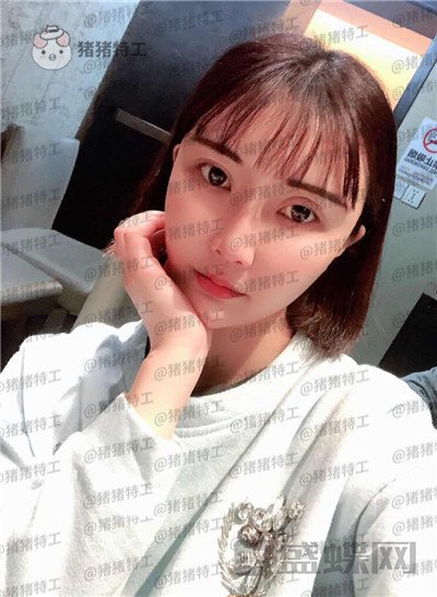 北京玲珑梵宫张殿祥面部填充案例价格分享,额头不完美对整张脸有多大影响?
