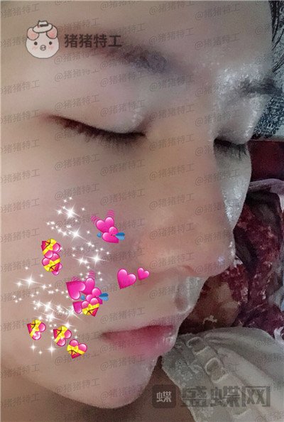 重庆中民整形科孙刚鼻部手术案例价格分享,本来就是小仙女做了鼻子气质升级。