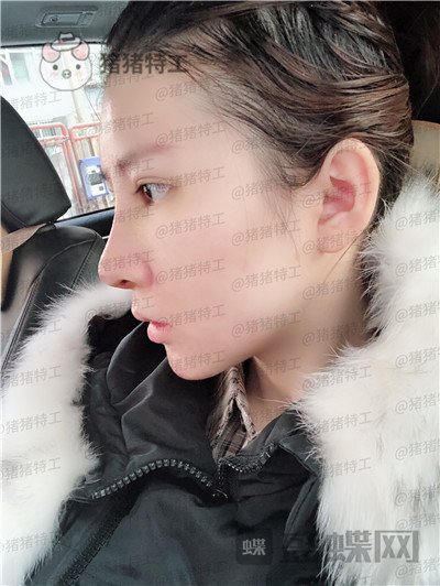 重庆中民整形科孙刚鼻部手术案例价格分享,本来就是小仙女做了鼻子气质升级。