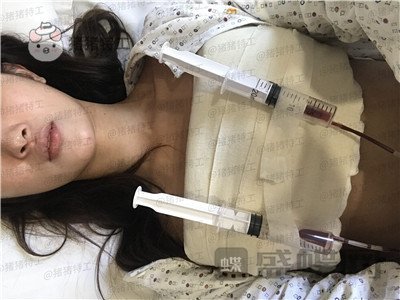 南京美贝尔黄名斗隆胸案例价格分享,变身性感女神婚后生活真美好~