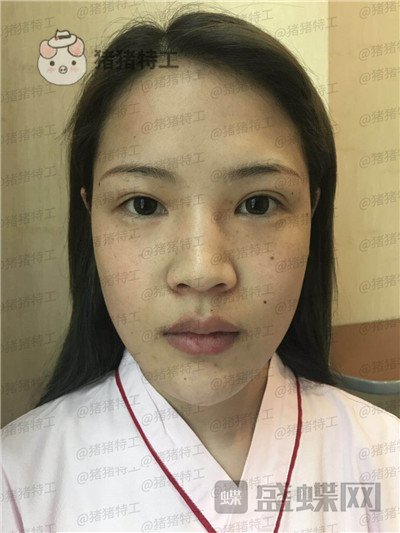 上海伯思立李茂群隆鼻案例价格分享,爸妈亲戚都夸我现在有多美。