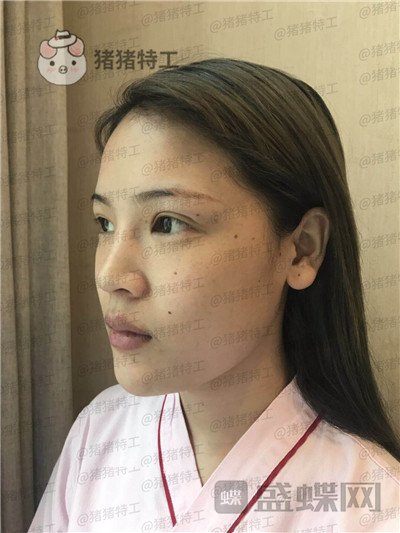 上海伯思立李茂群隆鼻案例价格分享,爸妈亲戚都夸我现在有多美。