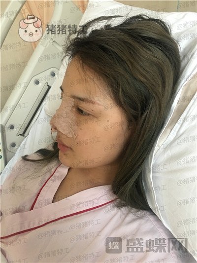上海伯思立李茂群隆鼻案例价格分享,爸妈亲戚都夸我现在有多美。