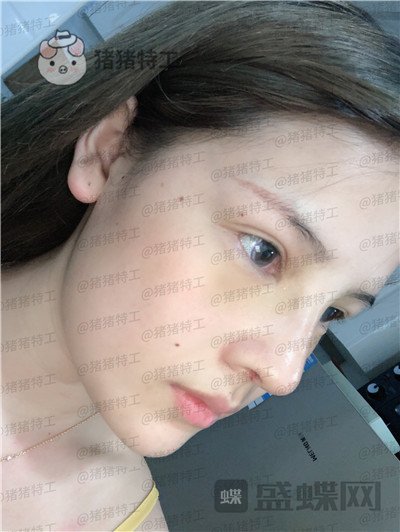 上海伯思立李茂群隆鼻案例价格分享,爸妈亲戚都夸我现在有多美。