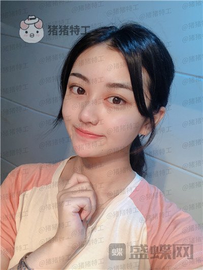 宁波珈禾费安军双眼皮案例价格分享,单眼皮但很大做完双眼皮果你懂得。