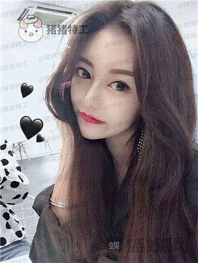 宁波珈禾费安军双眼皮案例价格分享,单眼皮但很大做完双眼皮果你懂得。