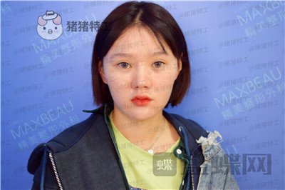 重庆精美田永华鼻部手术案例价格分享,短发女孩配好看的鼻子精致感get~