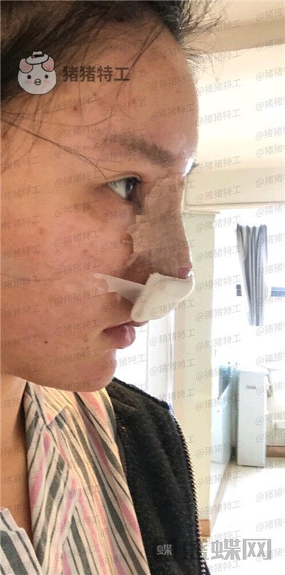 重庆精美田永华鼻部手术案例价格分享,短发女孩配好看的鼻子精致感get~