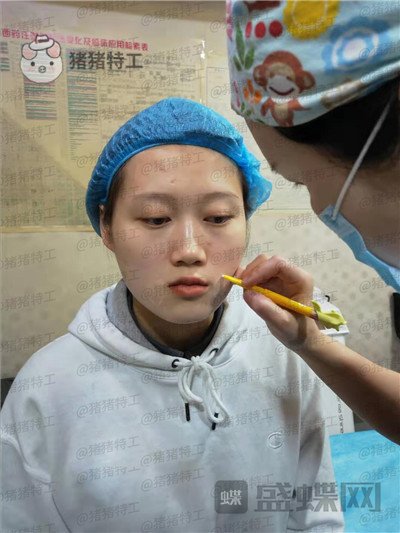 长沙晶肤朱苗注射瘦脸案例价格分享,竟然神奇的感觉骨骼都变小了!