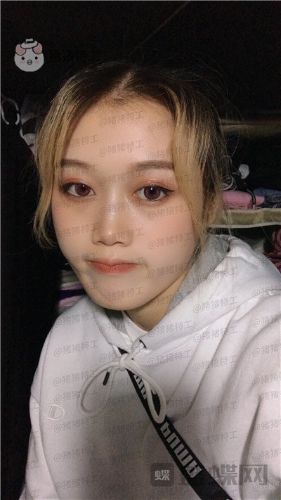 长沙晶肤朱苗注射瘦脸案例价格分享,竟然神奇的感觉骨骼都变小了!