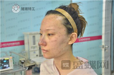 武汉希思特陈安云鼻部手术案例价格分享,好洋气的鼻子哈哈整个人气质都变高级了!