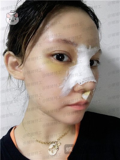武汉希思特陈安云鼻部手术案例价格分享,好洋气的鼻子哈哈整个人气质都变高级了!