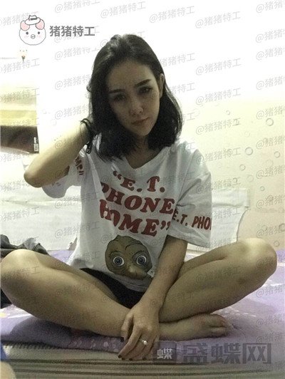上海欧莱吸脂案例价格分享,手臂粗显壮一次性解决。