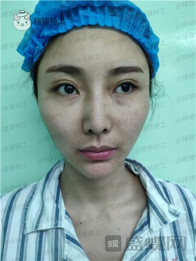 深圳恒生肖添有颧骨整形案例价格分享,颧骨高克夫?现在年轻又可爱。