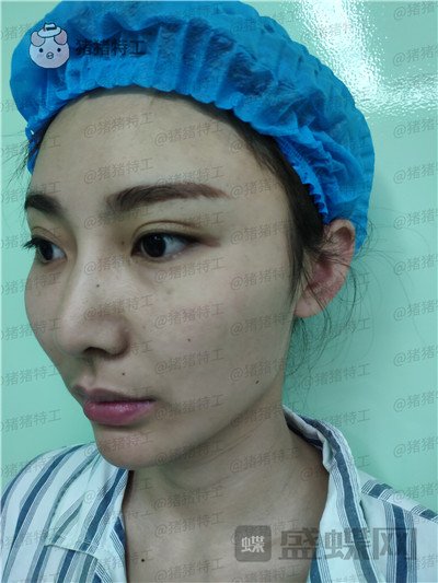 深圳恒生肖添有颧骨整形案例价格分享,颧骨高克夫?现在年轻又可爱。