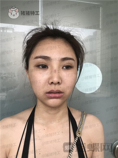 深圳恒生肖添有颧骨整形案例价格分享,颧骨高克夫?现在年轻又可爱。