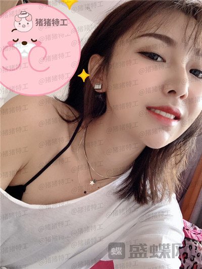 深圳恒生肖添有颧骨整形案例价格分享,颧骨高克夫?现在年轻又可爱。