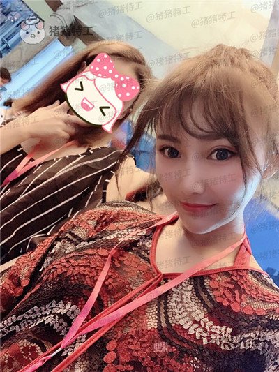 深圳恒生肖添有颧骨整形案例价格分享,颧骨高克夫?现在年轻又可爱。