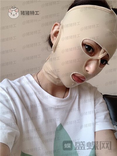 深圳恒生肖添有颧骨整形案例价格分享,颧骨高克夫?现在年轻又可爱。