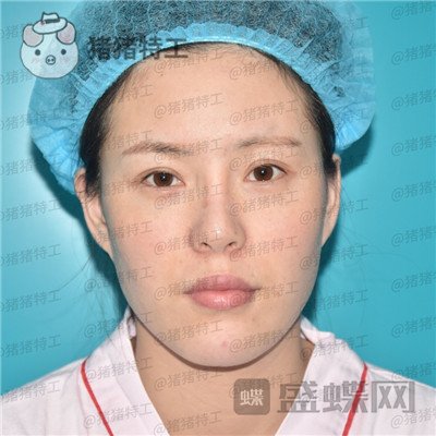 重庆百达丽黄伟光面部填充案例价格分享,想年轻就是这么简单~