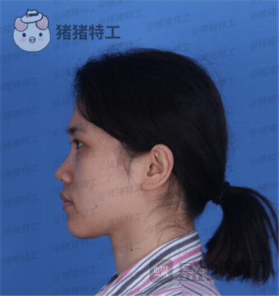 长春艾尔丽赵广文鼻部手术案例价格分享,做了鼻子改变了我的人生~