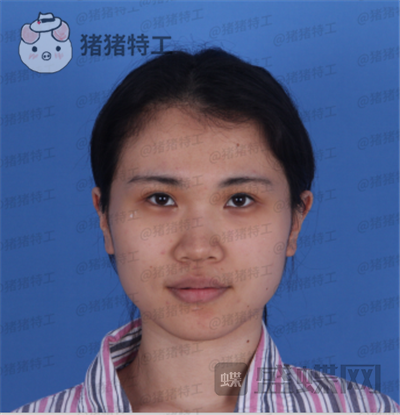 长春艾尔丽赵广文鼻部手术案例价格分享,做了鼻子改变了我的人生~