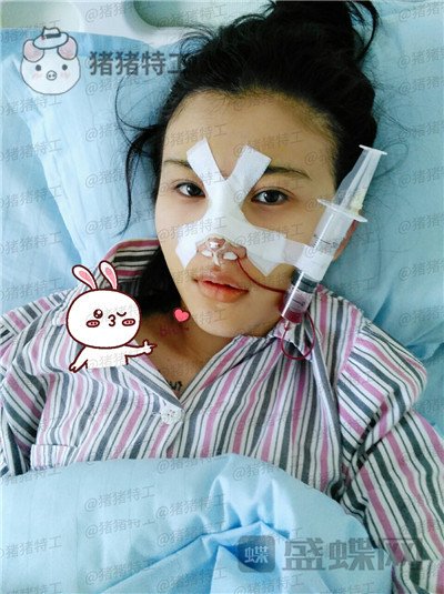 长春艾尔丽赵广文鼻部手术案例价格分享,做了鼻子改变了我的人生~