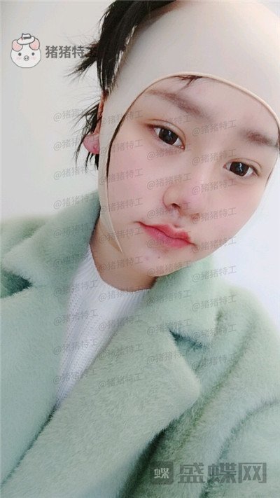 重庆玺悦台蒋福明面部吸脂案例价格分享,像娃娃一样的美少女你见过吗?