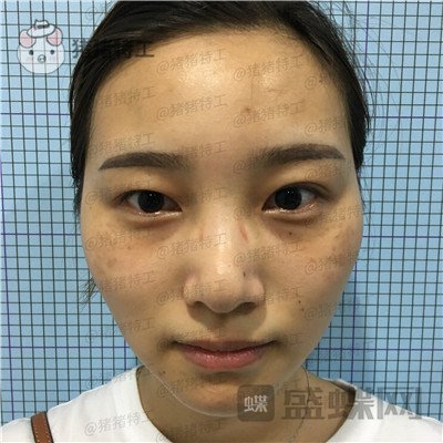 杭州格莱美王馨婉双眼皮案例价格分享,很可爱的眼睛真的好感度倍增~