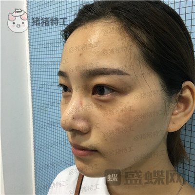 杭州格莱美王馨婉双眼皮案例价格分享,很可爱的眼睛真的好感度倍增~