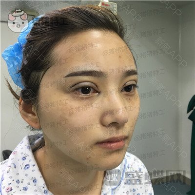 杭州格莱美王馨婉双眼皮案例价格分享,很可爱的眼睛真的好感度倍增~