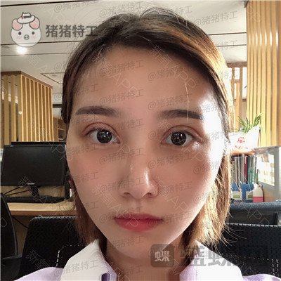 杭州格莱美王馨婉双眼皮案例价格分享,很可爱的眼睛真的好感度倍增~