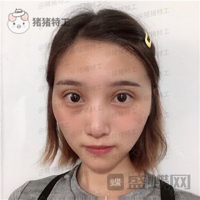 杭州格莱美王馨婉双眼皮案例价格分享,很可爱的眼睛真的好感度倍增~