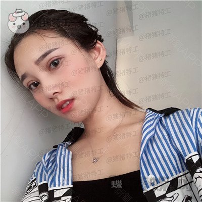 杭州格莱美王馨婉双眼皮案例价格分享,很可爱的眼睛真的好感度倍增~